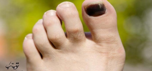 علت و روش درمان سیاه شدن ناخن پا