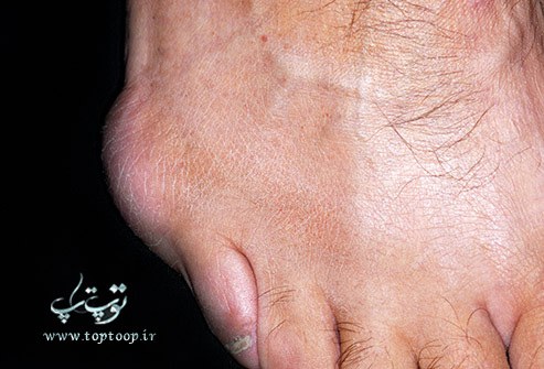 برجستگی کنار انگشت کوچک پا