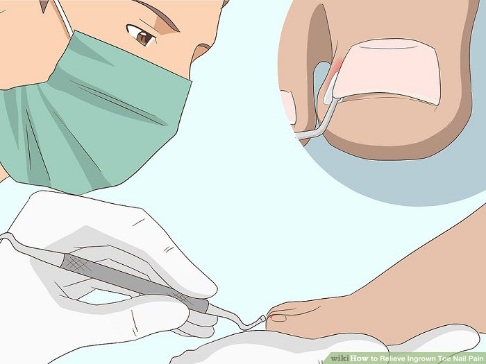 به پزشک اجازه دهید ناخن پا را بلند کند