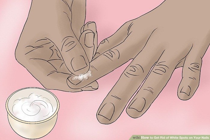درمان خانگی لکه های سفید ناخن