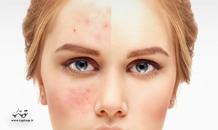 بهترین و بدترین غذاها برای پوست های آکنه دار
