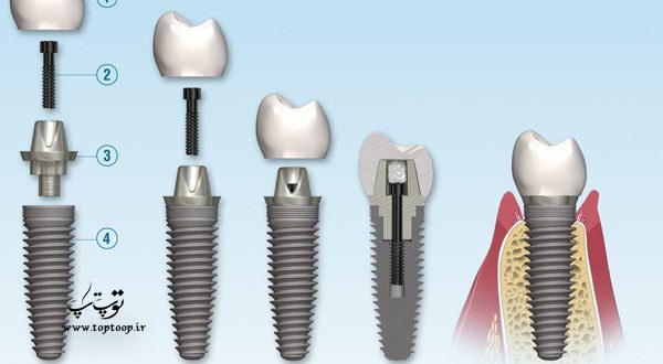 روش ایمپلنت دندان