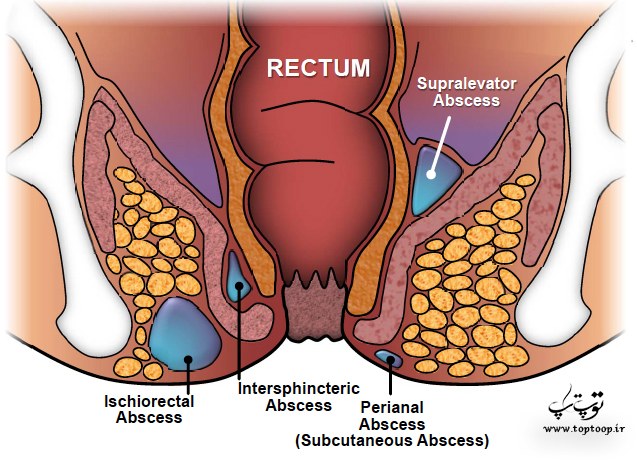 اطلاعات گسترده راجب آبسه و فیستول