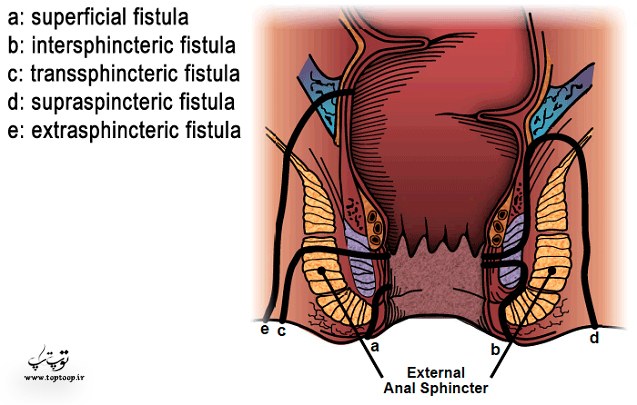 اطلاعات گسترده راجب آبسه و فیستول