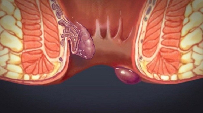 علائم بواسیر ، علل ، تسکین درد و درمان