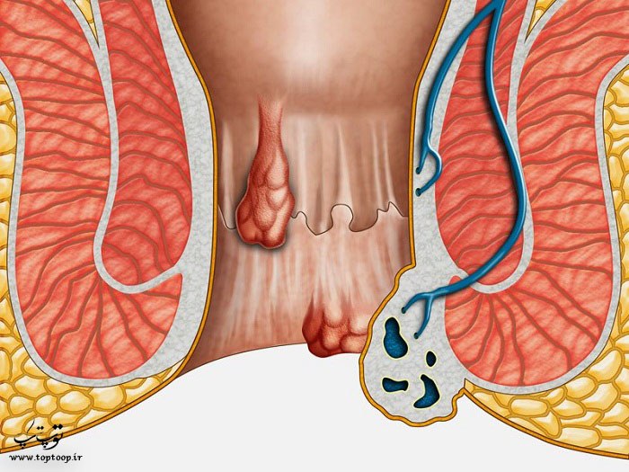 علائم بواسیر ، علل ، تسکین درد و درمان