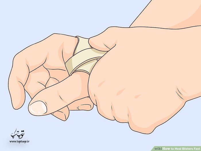 روش درمان تاول دست