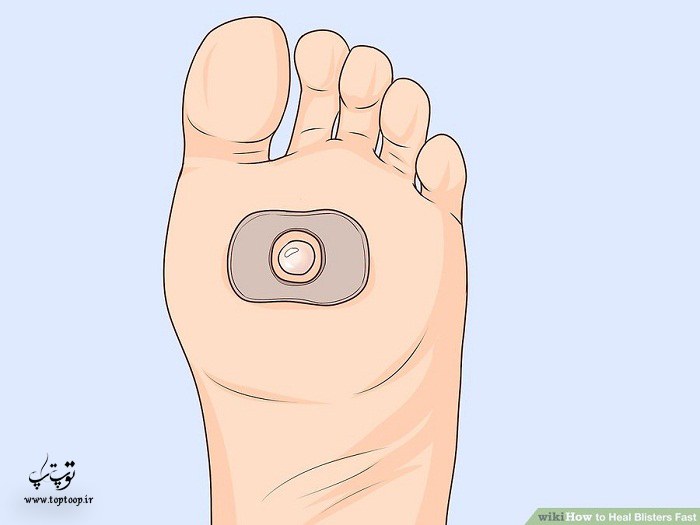 روش درمان تاول کف پا