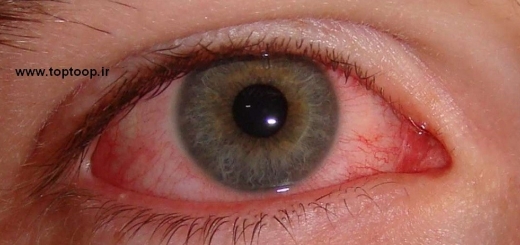 چرا چشم های من قرمز است؟