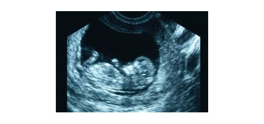 چرا سونوگرافی را در 3 ماه اول و سوم بارداری انجام میدهند